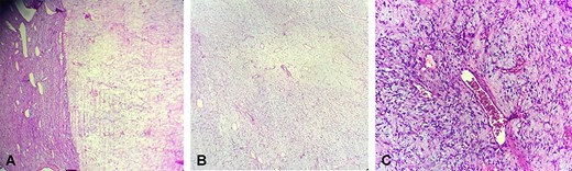 Microscopically, (a) showed alternation of hyper- and hypocellular areas (hematoxylin and eosin stain X10), (b) with spindle-shaped tumor cells and abundant blood vessels (hematoxylin and eosin stain X20)