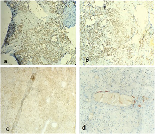 Positive staining with CD34 (a), desmin (b), progesterone receptor (c), estrogen receptor (d)