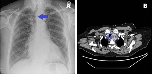 (A) Pre-admission chest radiograph highlighting visible tracheal deviation due to goitre (blue arrow). (B) Transverse CT image showing goitre relation to trachea (blue outline).