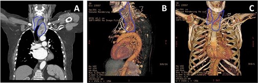(A) CT thorax showing the extension of the retrosternal goitre (blue outline), causing tracheal deviation with extension and abutting the distal ascending aorta and arch. (B) 3D-reconstructed CT thorax lateral view highlighting goitre (blue outline) relationship with respect to ascending aorta and arch, and other mediastinal structures. (C) 3D-reconstructed CT thorax allowed planning of mini-sternotomy in relation to goitre position.