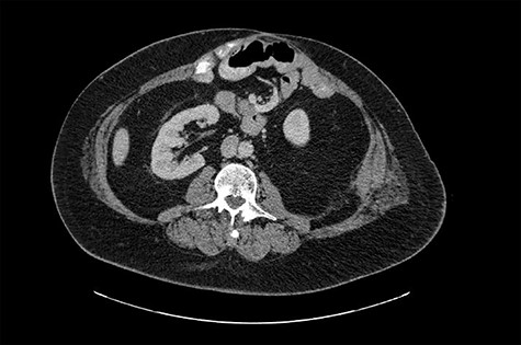 Computed tomography (CT) image from 2016 shows the right kidney in normal anatomical position.
