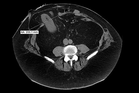 CT image from 2019 shows a prominent (2.3 cm ML) ventral hernia at the ostomy site, including portions of mesenteric/retroperitoneal fat, portion of right kidney, right proximal ureter and some bowel.