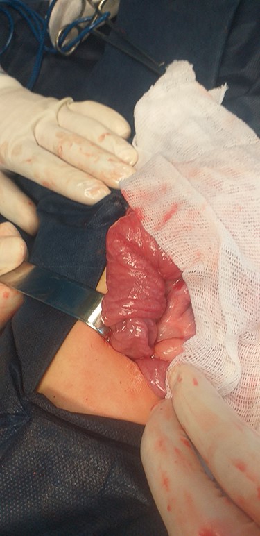 Postoperative ileoileal intussusception after surgical reduction.