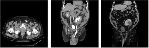 (a) Axial view of CT urogram showing left ureter folding on itself in the left inguinal canal. (b) Coronal view of CT urogram showing moderate-to-severe hydronephrosis and hydroureter of left kidney. (c) Coronal view of CT abdomen-pelvis showing peritoneal contents pulled into the large left inguinoscrotal hernia.