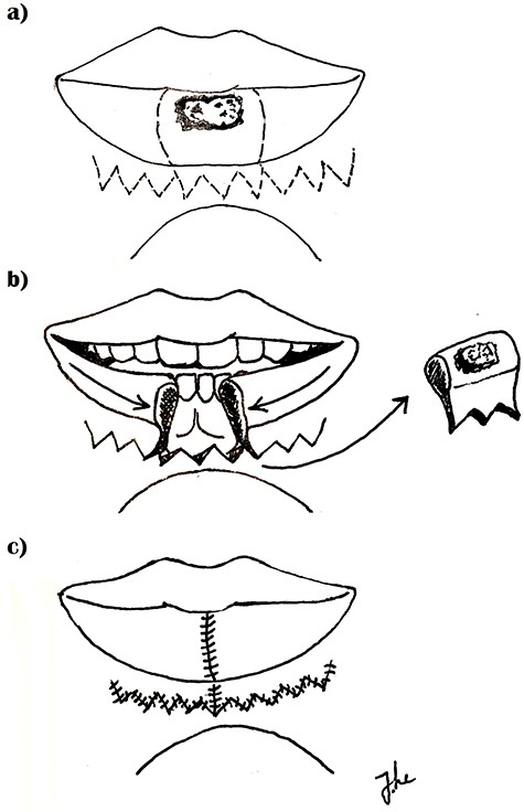 Flap design (a) incision marked (b) specimen excised, flap medially advanced (c) closure.
