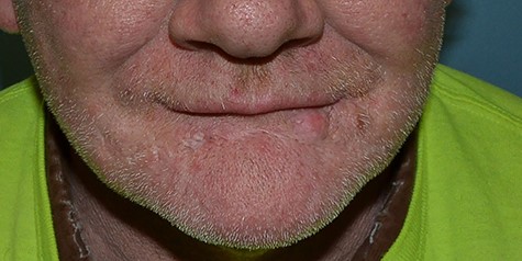 14 months following bilateral flap surgery.