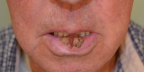 Squamous cell carcinoma of the lower lip affecting central lip.
