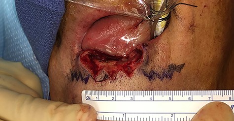 Lower lip defect after surgical excision with zigzag flap design drawn.
