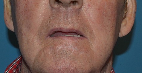 18 months following surgery.