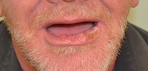 Squamous cell carcinoma of the lower lip affecting the midline to left commissure.