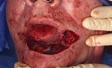 Lower lip defect after surgical excision.