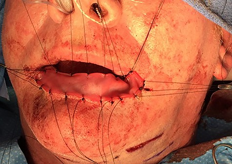 Placement of dermal scaffold.