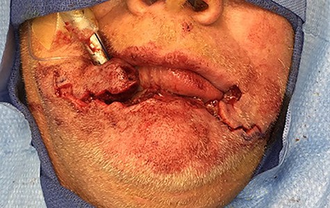 Lower lip defect prior to advancement of “bandoneon” flaps.