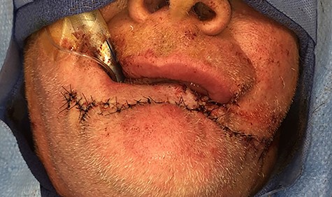 Three-layered closure.