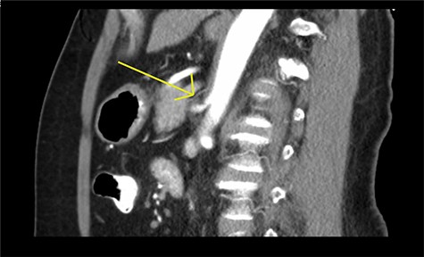 Preoperative CT scan. Legend: celiac artery stenosis (arrow).