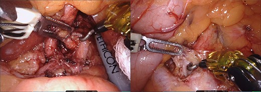 Intraoperative images during lymphanedectomy. Legend: left: lymphadenectomy on the left side of the celiac trunk. Right: lymphadenectomy on the right side of the celiac trunk.