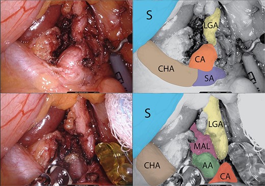 Arterial structures exposure. Legend: upper images: arterial structures before release of the MAL. Lower images: arterial structures during release of the MAL. S: stomach, CHA: common hepatic artery, CA: celiac artery, LGA: left gastric artery and SA: splenic artery.