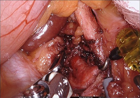 Completed dissection.