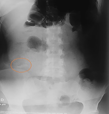 Abdominal X-ray shows a razor blade in the bowel.
