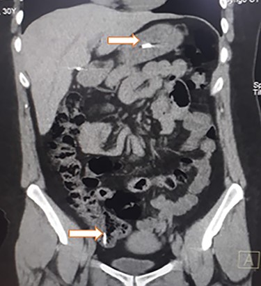 Abdominal CT, revealing two metal bodies, one in the stomach and one in the cecum.