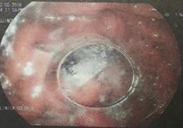 Upper endoscopy, the razor blade is seen embedded in the mucosa.