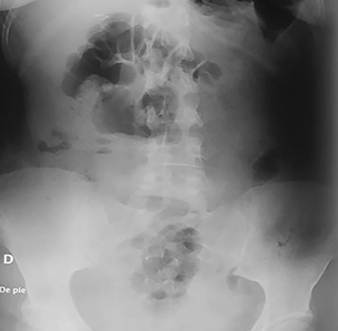 Abdominal X-ray on the postoperative period without any razor blades.