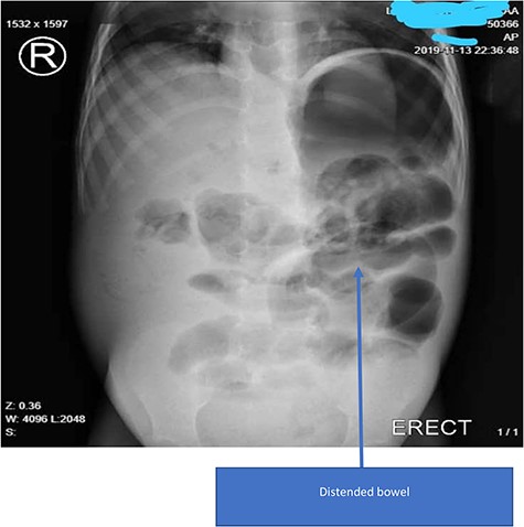 Plain X-ray of the patient showing gastrointestinal distention without air-fluid levels or ‘railway tracks’.