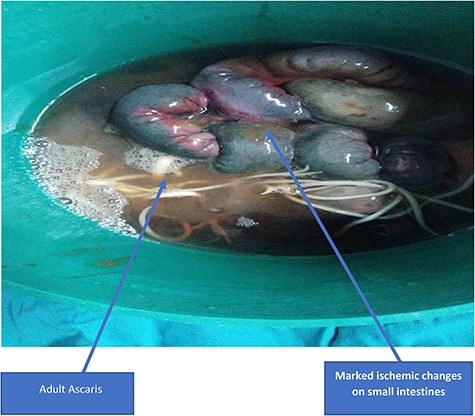 Marked ischemic changes of the small bowel with adult A. lumbricoides worms protruding from the bowel.