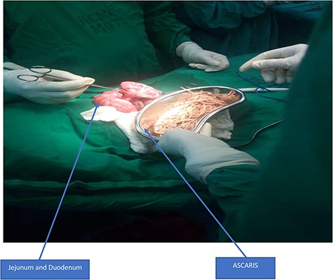 Extraction of A. lumbricoides from jejunum and duodenum by enterotomy.