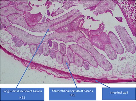 Showing A. lumbricoides on the sampled small bowel segment stained with H&E.