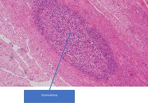 Infiltration of lymphocytic inflammatory cells with aggregation to form a granuloma in a necrotic tissue (H&E stains, ×100).