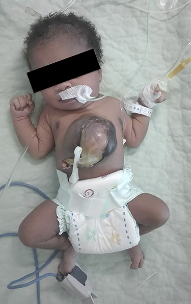 CS at birth.
