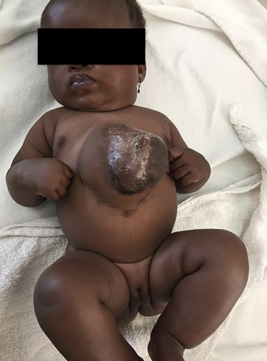 CS after 5 months of conservative treatment.