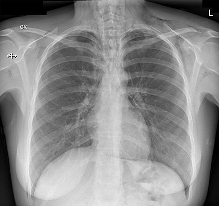 A chest radiograph illustrating surgical emphysema and pneumomediastinum.