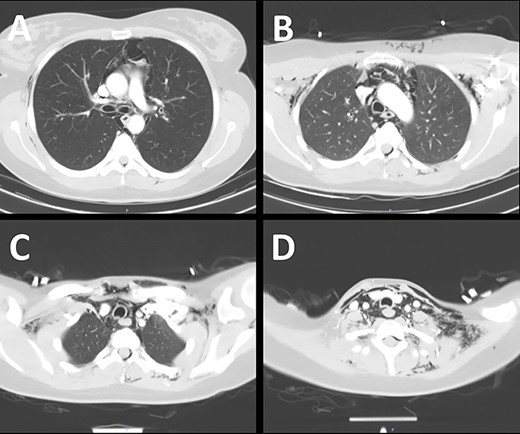 An enhanced CT scan of the neck and chest demonstrating extensive surgical emphysema and pneumomediastinum.