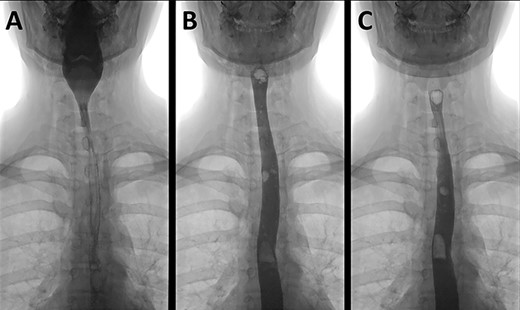 A water-soluble contrast swallow examination demonstrating contrast passing from the pharynx (A) through the oesophagus (B and C) with no evidence of leak.