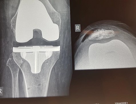 X-ray of patient’s knee following the total knee replacement with patella resurfacing.