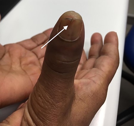 Right thumb with vertical split at the distal end of the nail plate.