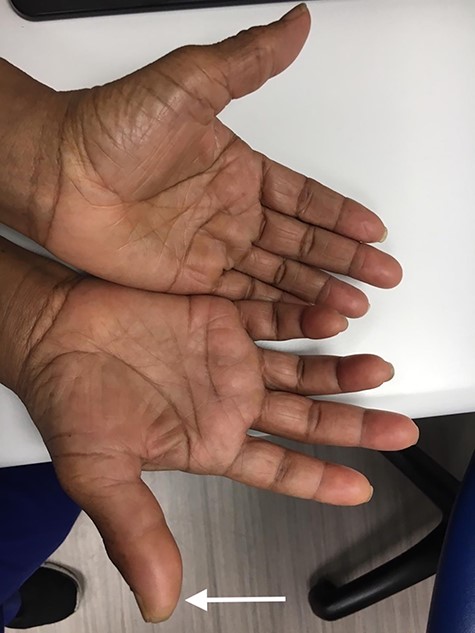 Bilateral hands demonstrating swelling of right thumb.