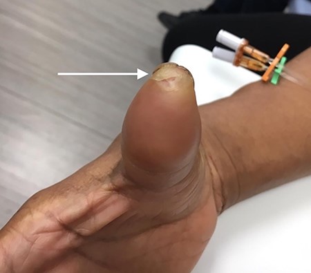 Tip of right thumb with peeling, devitalized skin.