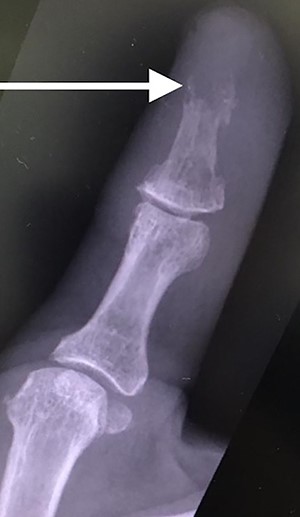 AP radiograph of right thumb showing erosion of tip of distal phalanx.