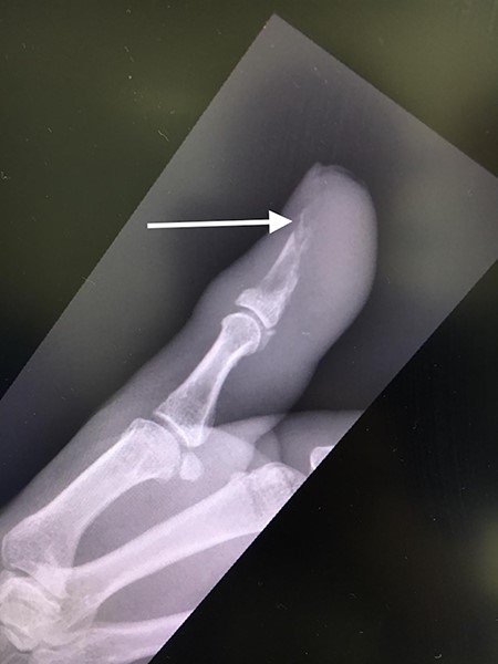 Lateral X-ray of right thumb showing erosion of tip of distal phalanx and soft tissue swelling.