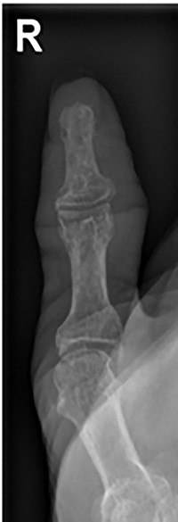 AP follow-up radiograph of right thumb 6 weeks post-admission showing resolution of lytic lesion.