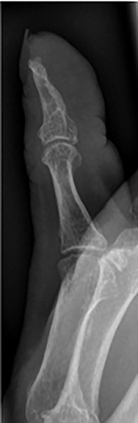 Lateral follow-up radiograph of right thumb 6 weeks post-admission showing resolution of lytic lesion.