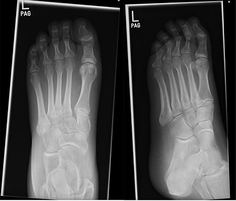 Initial foot X-rays (AP and lateral views), exhibiting normal appearances.