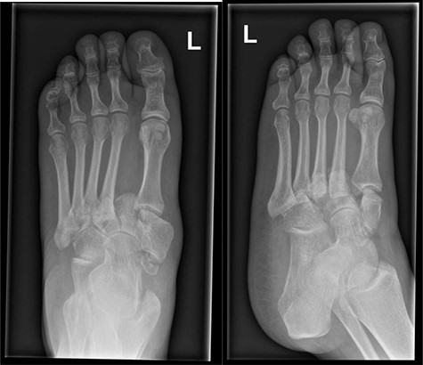 Foot X-rays taken at acute presentation (AP and lateral views), demonstrating rapid interval progression and destruction to mid-foot.