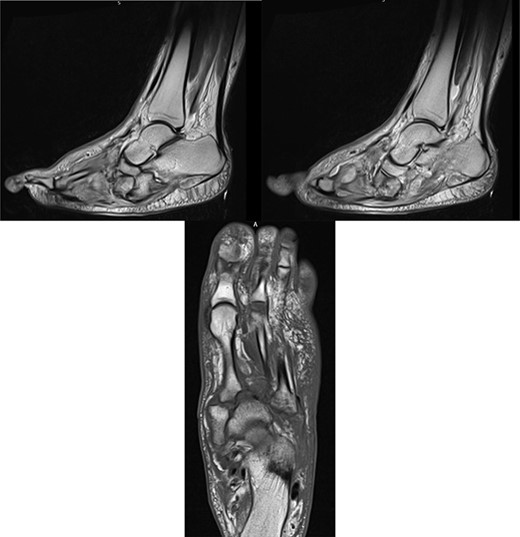 MR images, correlating plain film findings of acute mid-foot destructive changes; typical ‘rocker bottom’ appearance of plantar aspect of foot is seen.