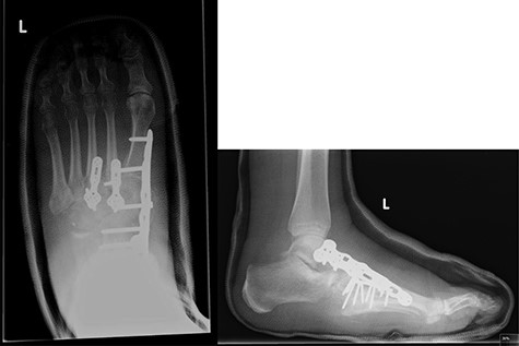 Post-operative X-rays (AP and lateral), demonstrating good reduction and fixation of fracture dislocations.