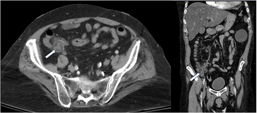 Cecal mass on CT A/P (white arrows).
