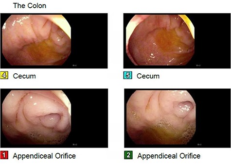 Absence of a cecal mass on colonoscopy, patent appendiceal orifice.